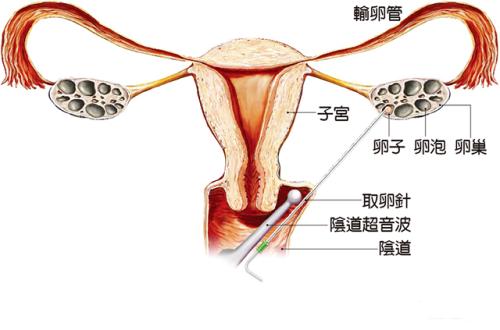 俄罗斯试管婴儿取卵