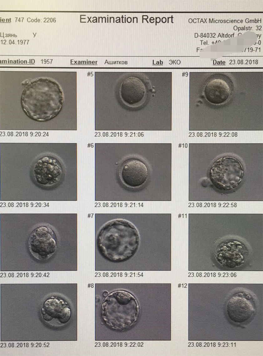 胚胎质量4AA