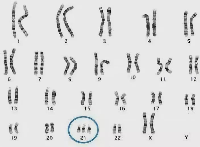21-三体综合征的染色体组30岁以下的女性生育的孩子患此病的概率为1