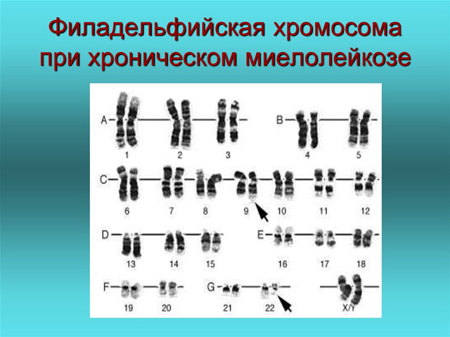 俄罗斯试管婴儿染色体异常